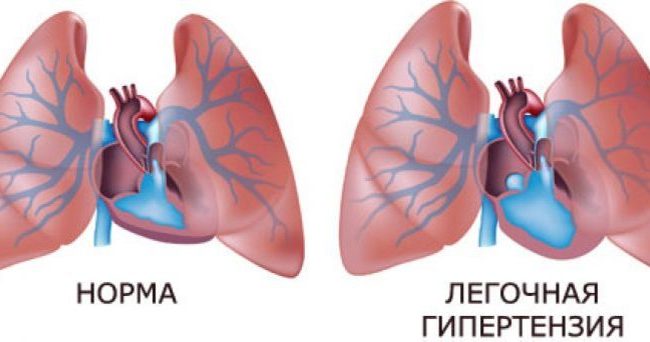 Расширение программы ВЗН за счет легочной артериальной гипертензии позволит уменьшит социально-экономическое бремя этого заболевания